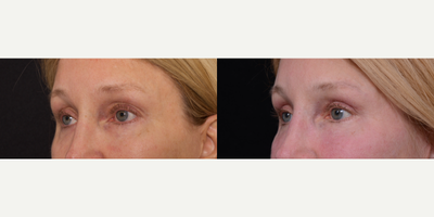Woman treated with Eyelid Surgery - Woman treated with Eyelid Surgery (upper eyelids)
