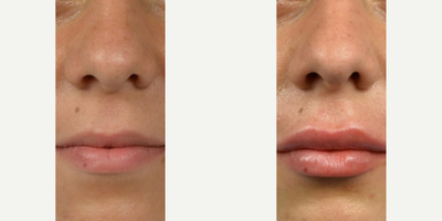 Juvederm, Lip Fillers, Lip Lift, Dermal Fillers - Woman treated with Juvederm, Lip Fillers, Lip Lift, Dermal Fillers