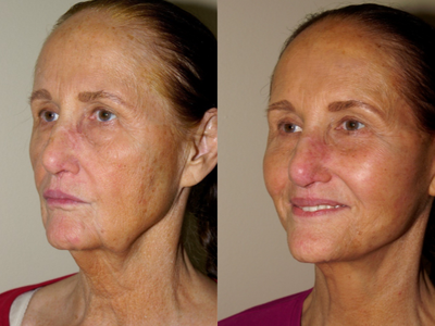 65-74 year old woman treated with Facelift - This patient was 72 years old and in good physical health at the time of her procedure. Her jawline and neckline improved significantly with the removal of fatty tissue and the softening of muscle bands. The entire process was carried out under a local anesthetic with sedation and performed as an outpatient. Most people do opt to recover in the comfort of their own home. Arrangements can always be made for a visiting nurse if one is desired.