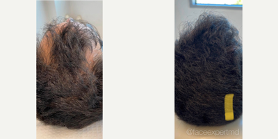 25-34 year old man treated with Hair Loss Treatment - 24K Gold Hair Treatment by Dr. Arash Moradzadeh