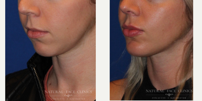 18-24 year old woman treated with Lip Fillers, Chin Implant - Patient wanted a chin implant to create a more symmetrical look.