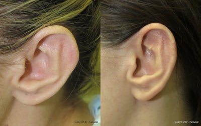 Ear shape correction - otoplasty - Otoplasty - ear correction does not always mean ear set back - ear shape can also be corrected removing extra bumps or changing shape