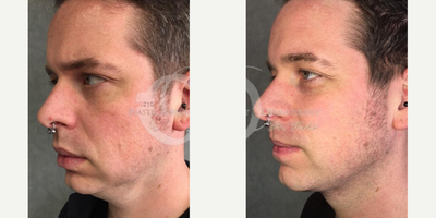 Man treated with Liposculpture - Man treated with Liposculpture