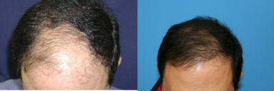 55-64 year old man treated with Hair Transplant - Procedure Details: Male 60 years old. Had 2 surgeries. Frontal (2053 grafts) and Frontal (1654 grafts)
