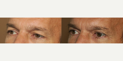 Man treated with Eyelid Surgery - Man treated with Eyelid Surgery
