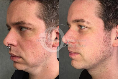 Man treated with Neck Lift - Man treated with Neck Lift