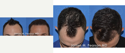 25-34 year old man treated with Hair Transplant - Hair Restoration using Follicular Unit Transfer. In this case, hair loss in the temporal areas was addressed with approximately 1500 grafts performed by Dr. James Pearson.