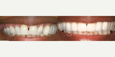 Patient treated with Smile Makeover - For this patient, we decided to do upper veneers to improve the position, shape, color, and relationship with the upper lip.
