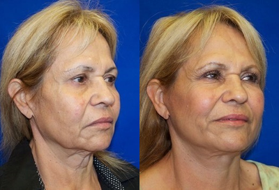 Woman over 60 years old treated with Laser Resurfacing - Woman over 60 years old treated with Laser Resurfacing