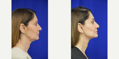 55-64 year old woman treated with Facelift, Buccal Fat Removal - facelift, lower blepharoplasty, buccal fat removal