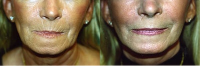 Laser Skin Resurfacing with Dr. Clevens -
Before and After Laser Skin Resurfacing