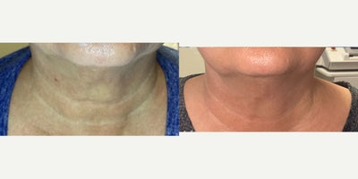 55-64 year old woman treated with Skin Rejuvenation - Female patient was treated for excess pigmentation, uneven texture to skin, deep wrinkles, crepey skin on neck, loss firmness, dullness, sun damage & aged appearance. Result was significant reduction in dark spots, improvement in firm and toned appearance,