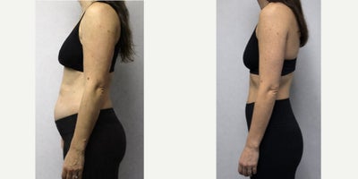 35-44 year old woman treated with Tirzepatide for Weight Loss - 37 year old woman treated with Semaglutide for Weight Loss