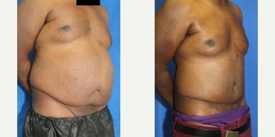 Abdominoplasty / Tummy Tuck Helps Male Patient Achieve a Flatter Midsection - Excess abdominal skin and fat can affect the overall appearance of the torso, especially when the lower abdomen hangs, creating an uneven contour. Our patient is a 54-year-old Black male who visited Dr. Katzen because he was concerned about the extra tissue around his abdomen. Dr. Katzen recommended a tummy tuck, also known as an abdominoplasty, to remove the excess skin and fat and improve the shape of his midsection. He was placed under general anesthesia for the procedure. During surgery, Dr. Katzen removed the hanging lower abdominal tissue and tightened the abdomen to create a smoother, flatter contour. An abdominoplasty can help patients with abdominal skin laxity, lower belly overhang, and fullness that make the stomach look less defined. Photos were taken 4 months after surgery, and our patient achieved remarkable results. His abdomen now appears flatter, smoother, and more balanced with the rest of his body. This case demonstrates how male tummy tuck surgery can improve the lower abdomen, waistline, and overall torso shape through a customized body contouring approach. Dr. Katzens approach focused on removing the extra tissue while keeping the result proportional to his body. The procedure helped reduce the lower abdominal fold, improve the waistline, and create a more structured abdominal profile that better matched his overall frame. His early healing shows a cleaner shape. The final contour looks more balanced.