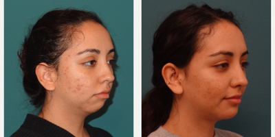 18-24 year old woman treated with Chin Implant - This young female presented with a retrusive chin and desired a more natural look in particular on her profile. A 7mm Medpore implant was placed with small extensions to even out the chin to jaw contour. The implant is screwed in place so it will never move. Medpore is an excellent material as it mimics the consistency of the underlying skeleton giving a very natural shape and feel.