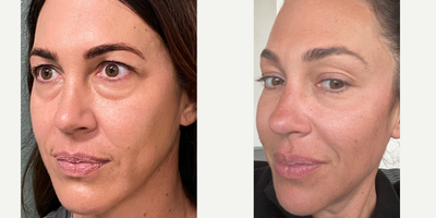 35-44 year old woman treated with Plasma Pen - Plasma pen to lower lids. 1 syringe filler was also done to the tear trough.