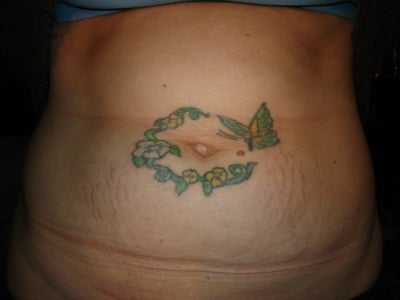 Laser Tattoo Removal Before Tummy Tuck? Doctor Answers, Tips