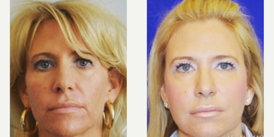 Woman treated with Restylane, Dysport - Works with your body to make new collagen, producing a natural-looking result over time. Facial rejuvenation with sculptra and take advantage of deep discounts on sculptra, restylane and dysport.