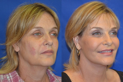 50-59 year old woman treated with CO2 Laser - 50-59 year old woman treated with CO2 Laser