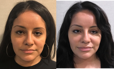 25-34 year old woman treated with Restylane - My 27-year-old patient 2 weeks after Belotero filler to the under eye, Restylane Lyft to the cheeks, and Restylane to the lips. She has received many compliments at work and they arent sure why she looks better.