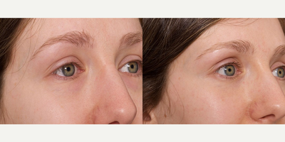 Woman treated with Eyelid Surgery - Woman treated with Eyelid Surgery