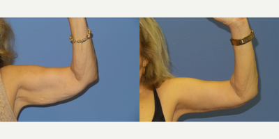 75 year old woman treated with Arm Lift - 75 y/o female who is shown 6 months after a brachioplasty and tummy tuck. She used Embrace scar therapy to both areas.
