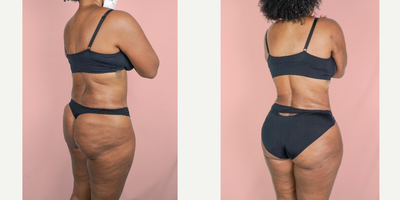 25-34 year old woman treated with Liposuction, Brazilian Butt Lift - This patient had a prior tummy tuck but was unhappy with the contouring of her body and wanted improved shape around her torso and hips. She underwent a 360 Liposuction and Fat transfer and is shown 6 months after surgery.