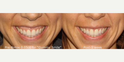 25-34 year old woman treated with Botox - Before and After photo of female patient with Botox treatment for Gummy Smile