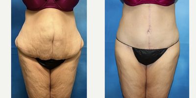 35-44 year old woman treated with Tummy Tuck Revision, Body Lift - 36 year old post bariatric patient with an over 200 lb weight loss. Dr. Frank performed a revision to her abdominoplasty (Fleur De Lis) with a completion of a belt lipectomy.