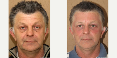 Man treated with Eyelid Surgery - Man treated with Eyelid Surgery