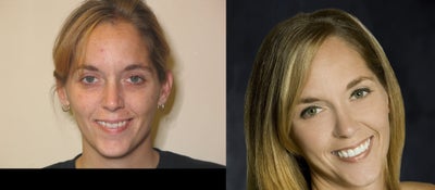 Porcelain Veneers -
Enhance Smile