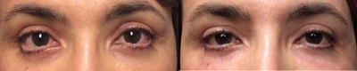 45-54 year old woman treated with Eyelid Retraction Repair - Patient underwent transcutaneous lower lid bleph by an outside plasic sugeon with aggressive fat and skin excision more on the right than left. She was left with lower lid retraction more right then left. I treated her with several rounds of 5FU injections and a lid stenting procedure with Restylane. These pictures are pre injections and immediately after filler via cannula