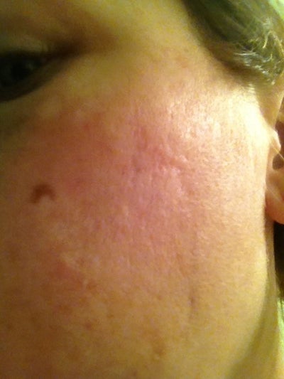 What treatment would be best for acne scars and brown sun What treatment would be best for acne scars and brown sun