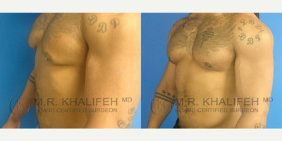 35-44 year old man treated with Gynecomastia Surgery - Body builder exhibiting gynecomastia, removed under local anesthesia with minimally visible scars.