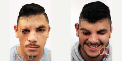 Man treated with Beard Transplant - The Doctor Reconstructs Teens Eyebrow and Beard With Leg Hair