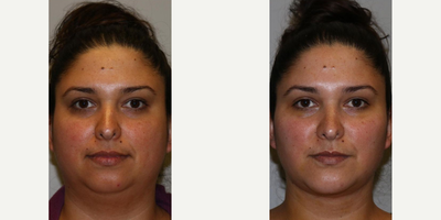 Woman treated with Buccal Fat Removal - Woman treated with Buccal Fat Removal to thin the cheeks and face, shown 5 days post op. She also had Chin Implant to enhance jawline as well as Chin Liposuction to contour neck/chin area, Facial Fat Transfer to shape and contour the face, and FaceTite to thin the cheeks and face.