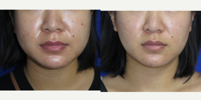 29 year old woman treated with Buccal Fat Removal - This 29 year old female patient did not like the fullness from her lower cheek area. She had Buccal Fat Pad Removal under local anesthesia and oral sedation.