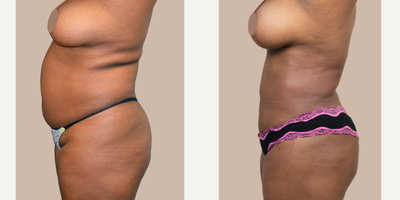35-44 year old woman treated with Liposuction - This patient underwent a 360Lipo to remove fat that was resistant to exercise and diet. She is shown 3-months post-op.
