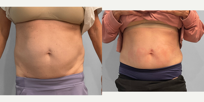 45-54 year old woman treated with Emsculpt - This woman in her mid-sixties wished to improve the appearance at strength of her core. She met with our body contouring specialist Jessica and chose to proceed with a set of four Emsculpt Neo sessions to her abdomen. She looks amazing and is featured before and 2 months after her fourth session.