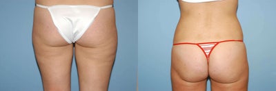 Vaser Liposuction - At 23 this woman found that no matter how much she exercised she couldn't get any results at her hips and inner and outer thighs. Not that she was fat, not at all. In fact, whe was in excellent shape.
But nature helps extra stores of fat in her hips (Love Handles) and inner and outer thigs. Her liposuction was a simple outpatient procedure for her.