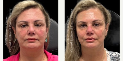 45-54 year old woman treated with Cheek Fillers, Dermal Fillers, Lip Fillers, Volbella, Voluma, Liquid Facelift, Juvederm, Botox - This 45-54 year old female patient received 2cc of Juvederm Voluma in the cheeks, 1cc of Juvederm Volbella in the lips, and 50 units of Botox for a full facial refresh. Her results show lifted, more defined cheeks, smoother skin, and softly enhanced lips for a balanced, rejuvenated appearance with natural-looking results.