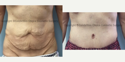 35-44 year old man treated with Male Tummy Tuck - This patient had abdominoplasty after massive weight loss.