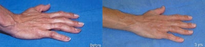 45-54 year old woman treated with Hand Rejuvenation - Procedure: Fat injection of hands
