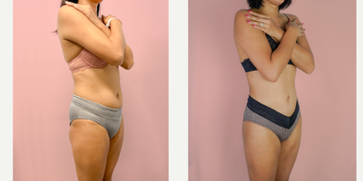 25-34 year old woman treated with Liposuction, Tumescent Liposuction, Vaser Liposuction - This lovely patient requested liposuction to improve her contour, shape and curves. After she explained her goals, we planned to remove fat from unwanted areas and enhance her curves. She is shown 4 months after liposuction.