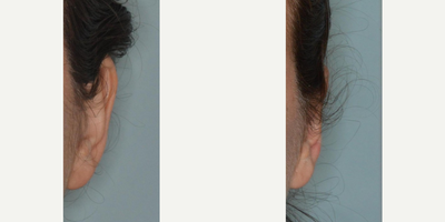 18-24 year old woman treated with Ear Surgery - Before and after an otoplasty procedure.