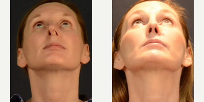 Woman treated with Rhinoplasty - Rhinoplasty