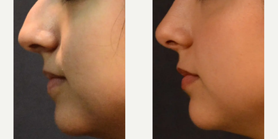 Woman treated with Rhinoplasty - Rhinoplasty