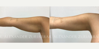 25-34 year old woman treated with Arm Lift - 25-34 year old woman treated with Arm Lift- 4 months post-op