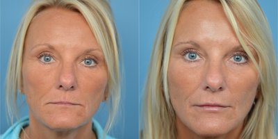 45-54 year old woman treated with Juvederm - 49 year old patient concerned with thin lips. She was treated with Juvederm to add volume.