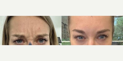 Woman treated with Botox - Woman treated with Botox.